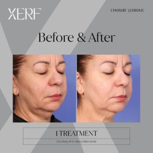 xerf before & after