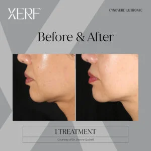 XERF Skin Tightening Mississauga
