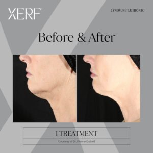 XERF Skin Tightening Mississauga