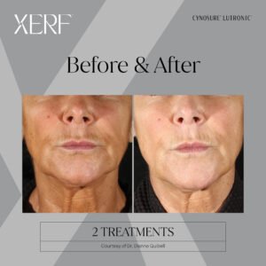 XERF Skin Tightening Mississauga