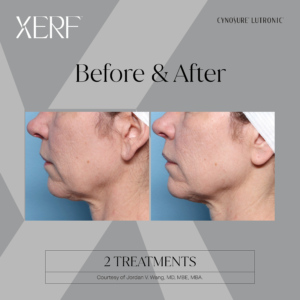 XERF Skin Tightening Mississauga