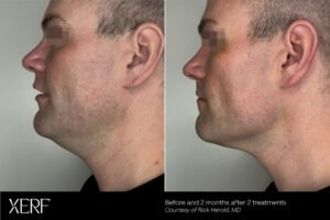 XERF Skin Tightening Mississauga